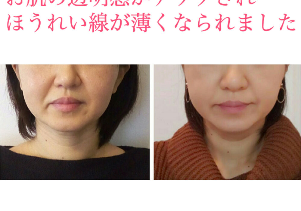 ビフォーアフター写真